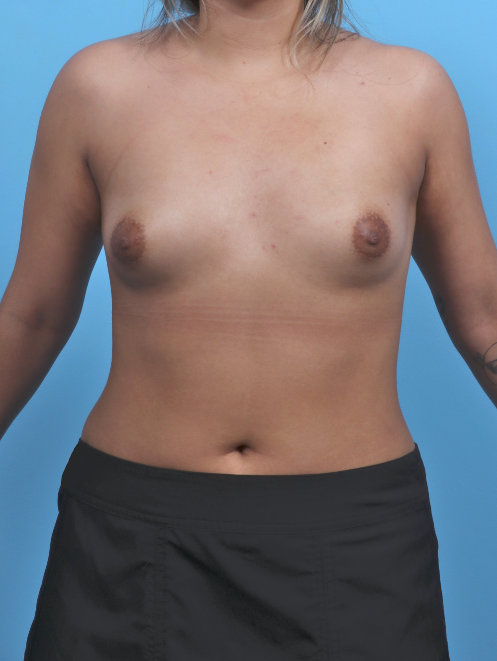 Breast Augmentation Patient Photo - Case 5968 - before view-