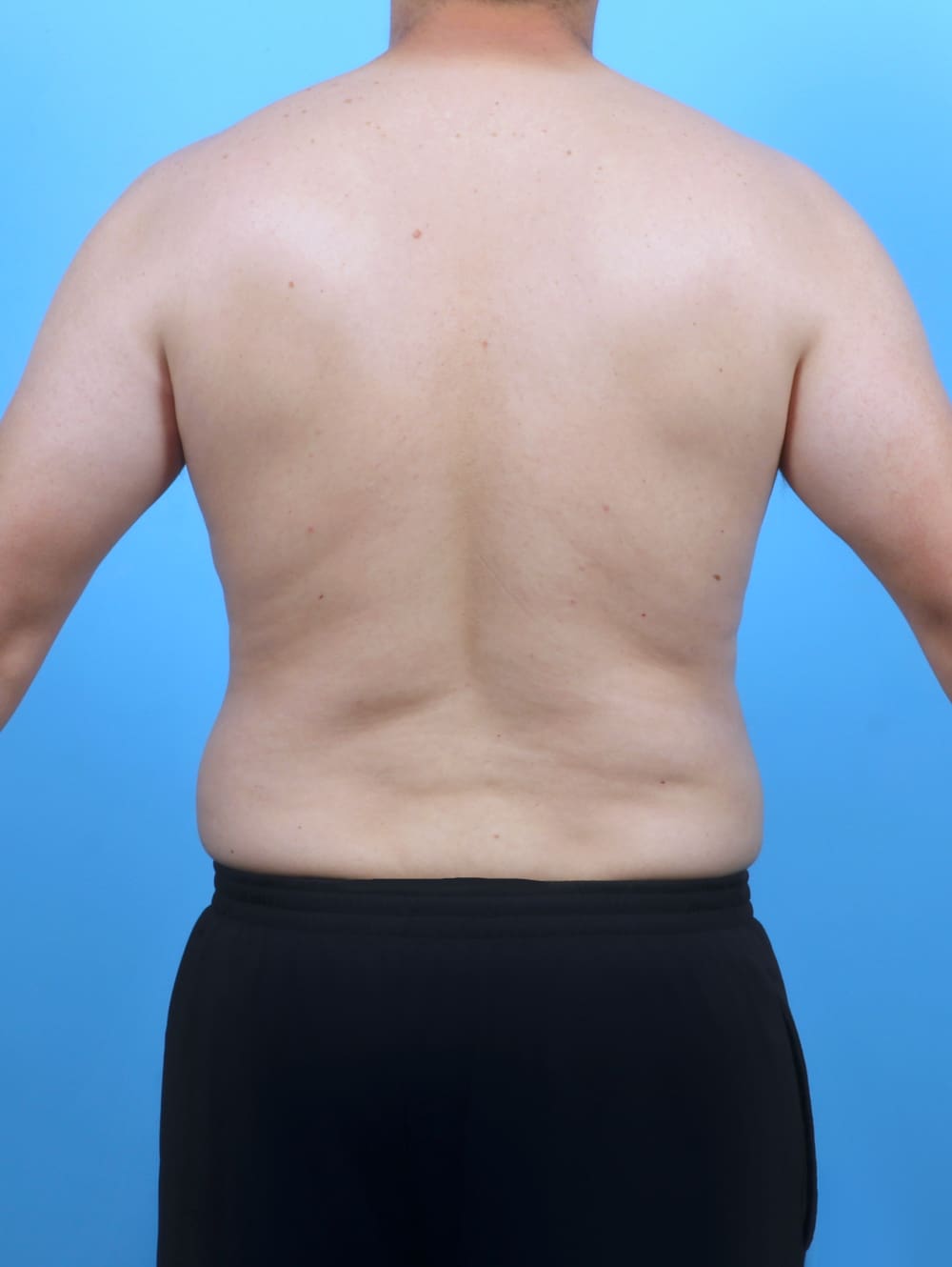 Liposuction Patient Photo - Case 5992 - after view-3