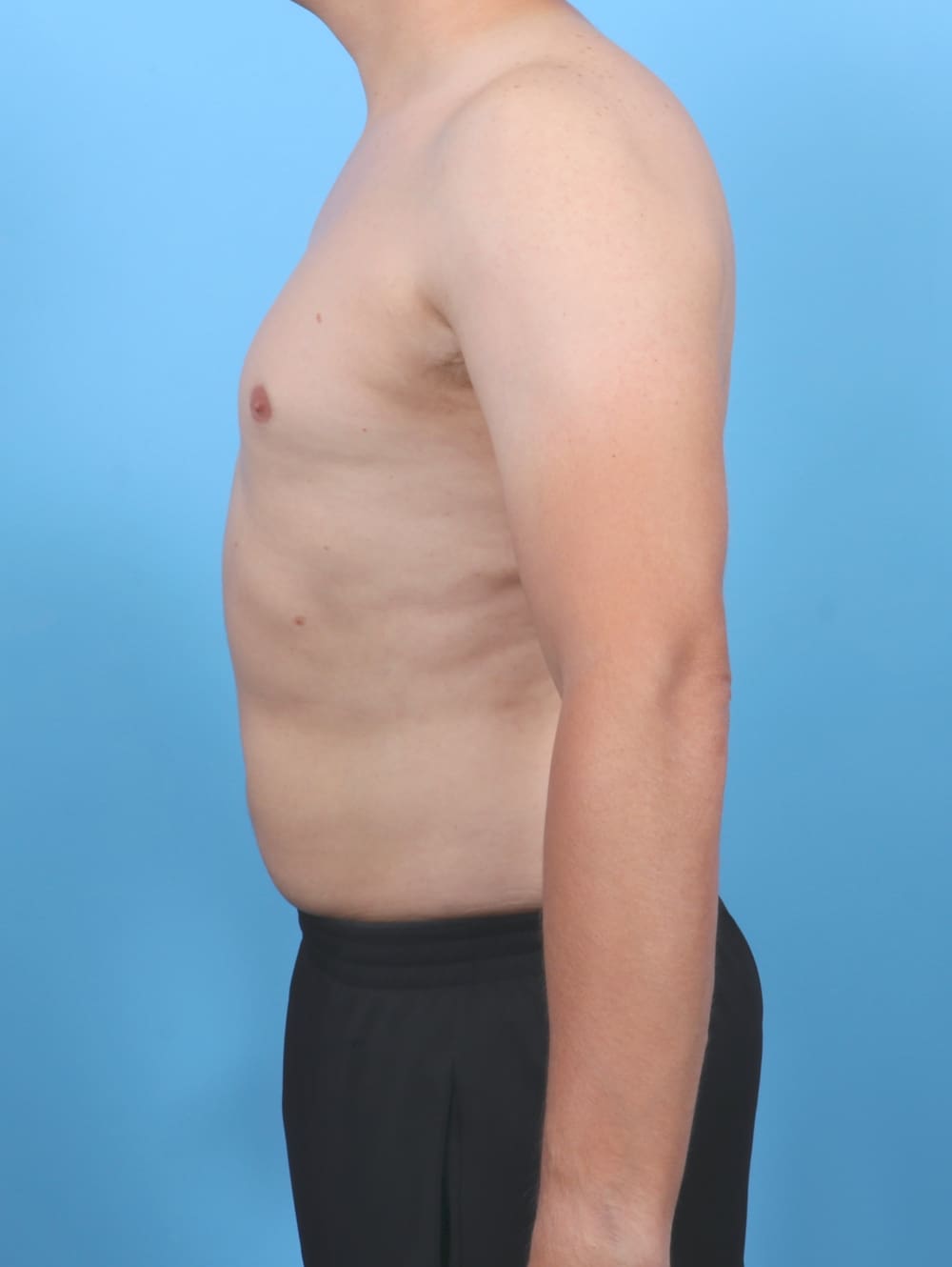 Liposuction Patient Photo - Case 5992 - after view-2