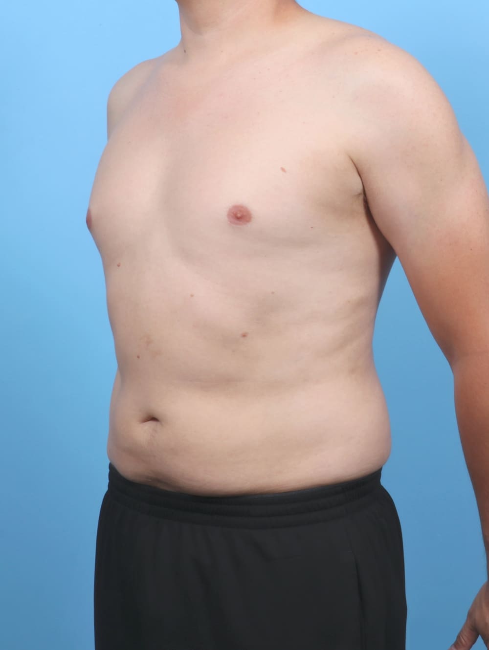 Liposuction Patient Photo - Case 5992 - after view-1