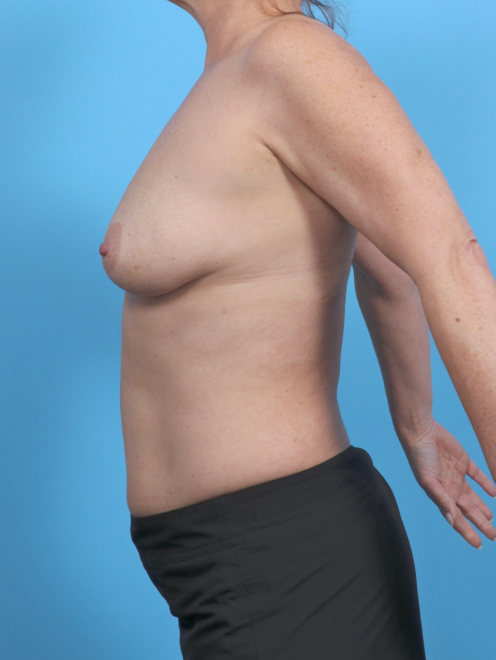 Breast Lift with Implants Patient Photo - Case 6042 - before view-2
