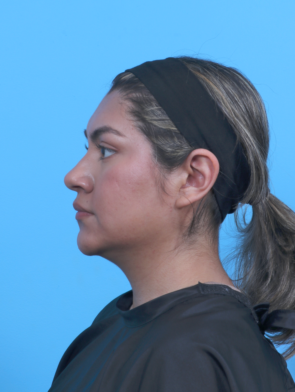 Rhinoplasty Patient Photo - Case 6066 - before view-0