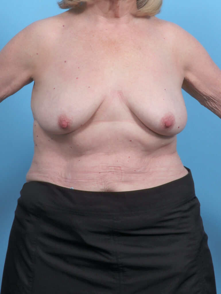 Breast Lift/Reduction - Case 6114 - Before