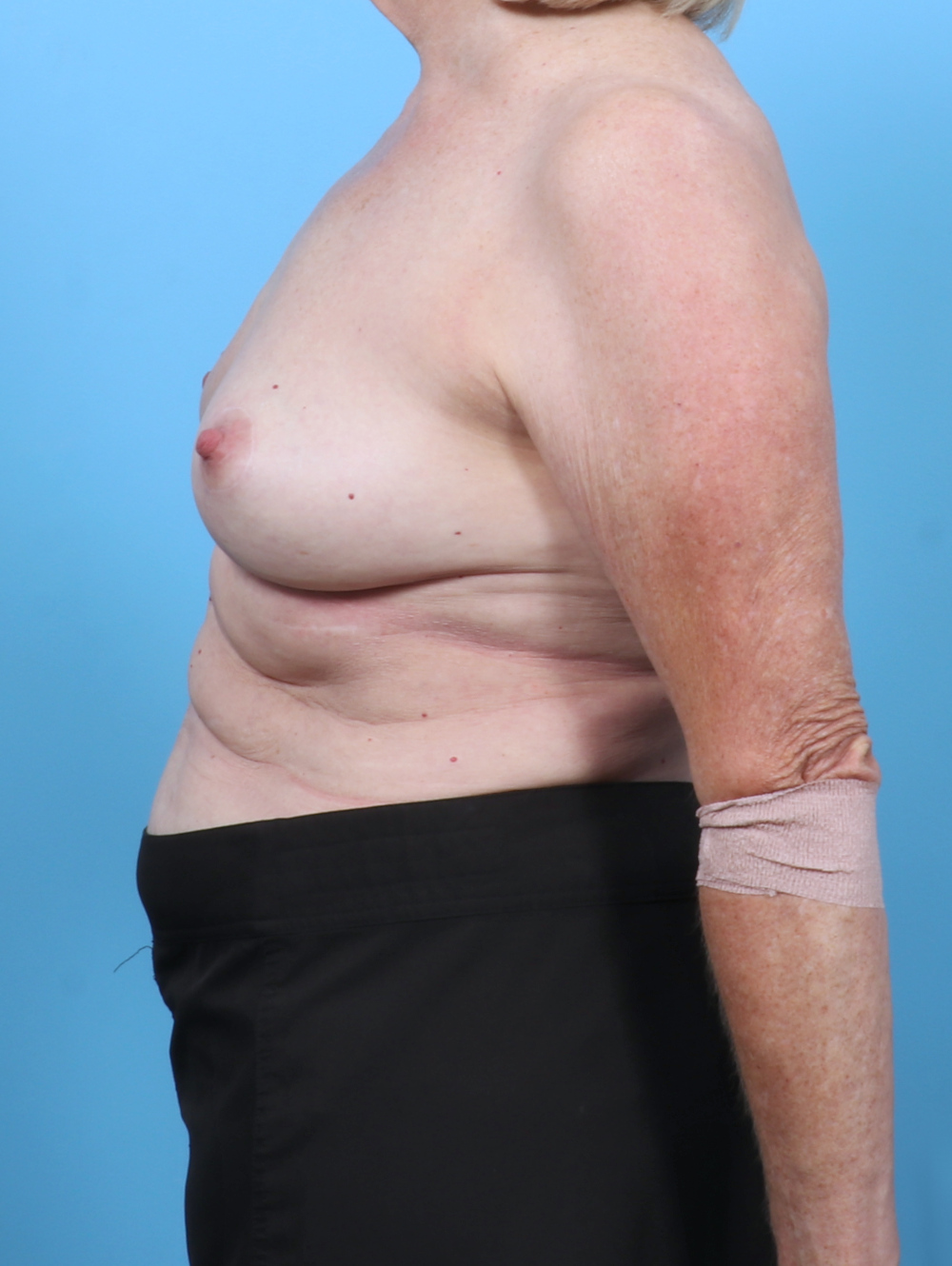 Breast Lift/Reduction Patient Photo - Case 6114 - after view-2