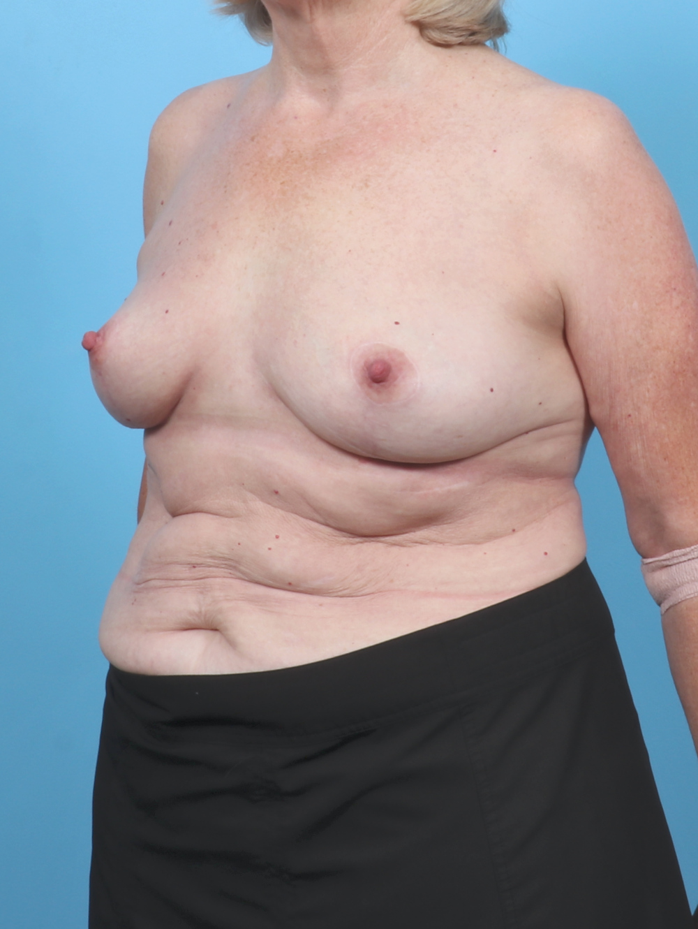 Breast Lift/Reduction Patient Photo - Case 6114 - after view-1