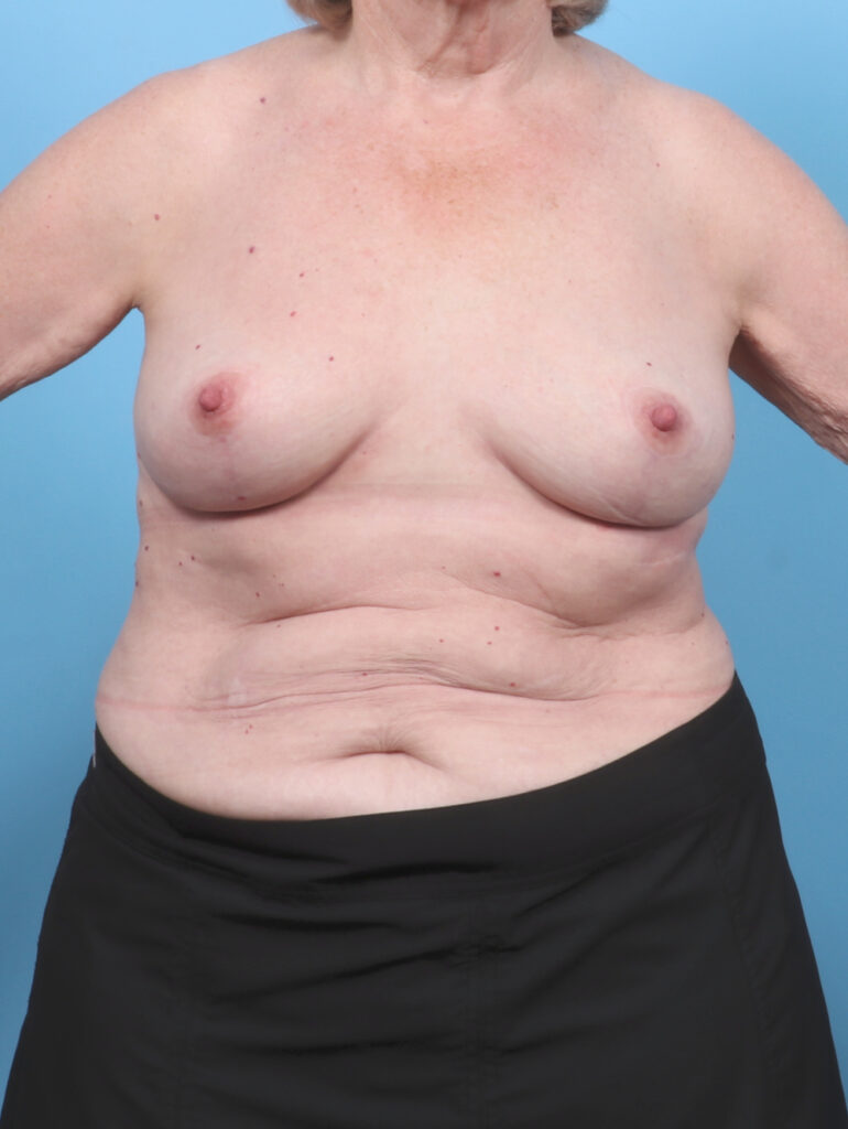 Breast Lift/Reduction - Case 6114 - After