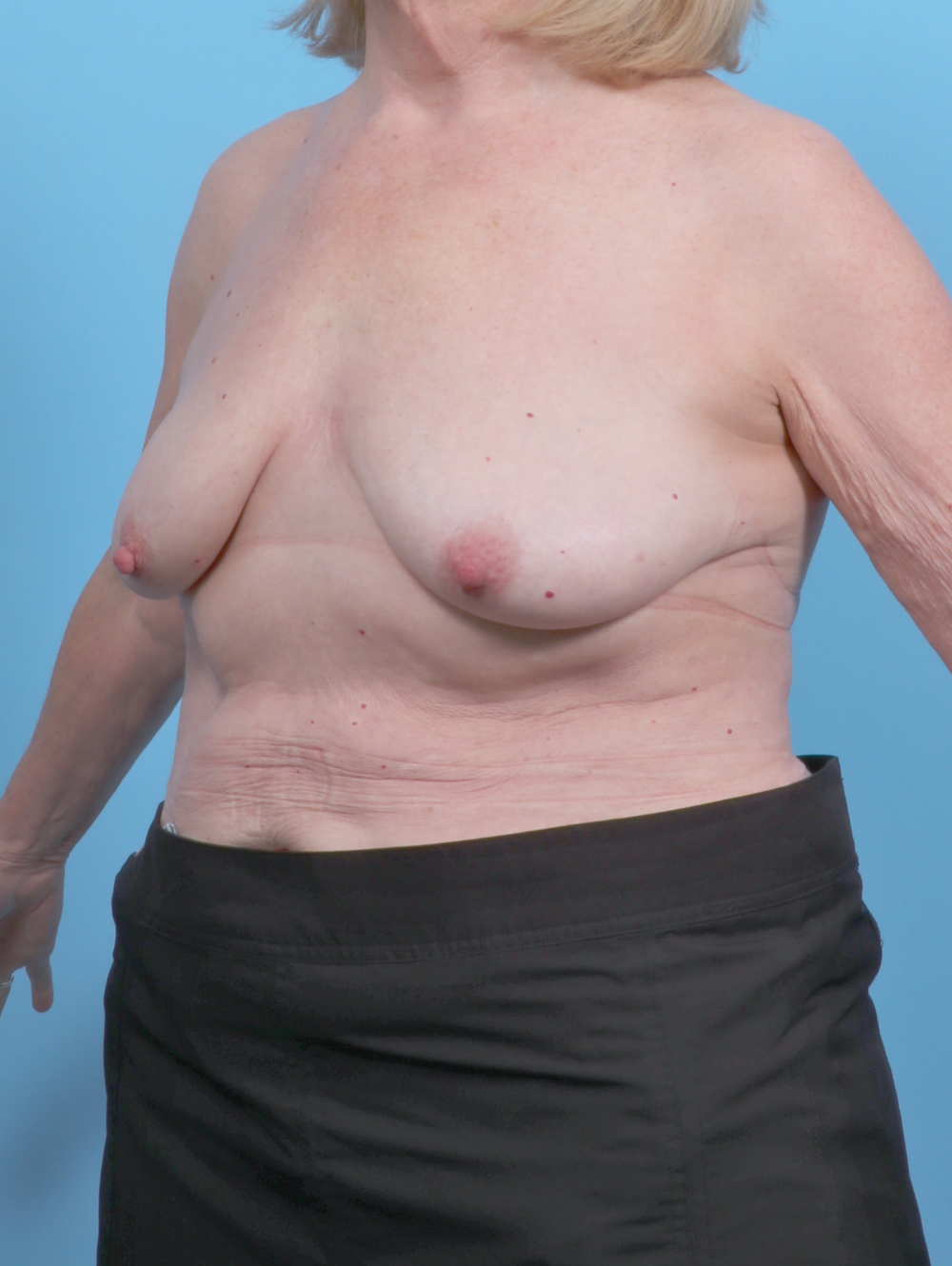 Breast Lift/Reduction Patient Photo - Case 6114 - before view-1