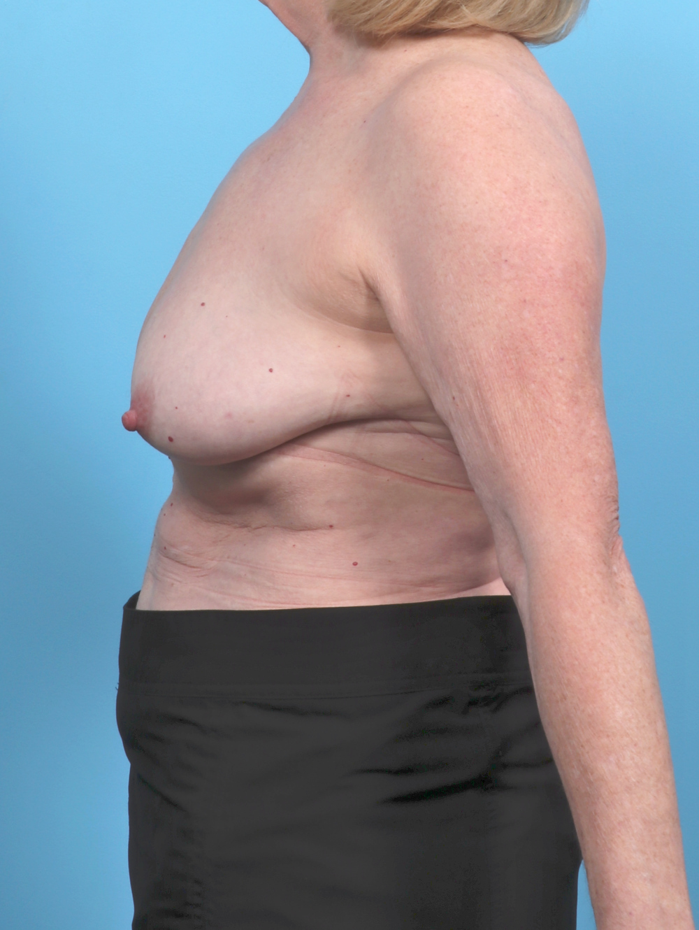 Breast Lift/Reduction Patient Photo - Case 6114 - before view-2