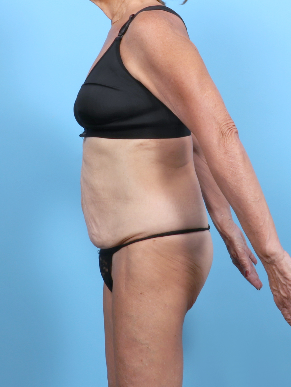 Tummy Tuck Patient Photo - Case 6189 - before view-2