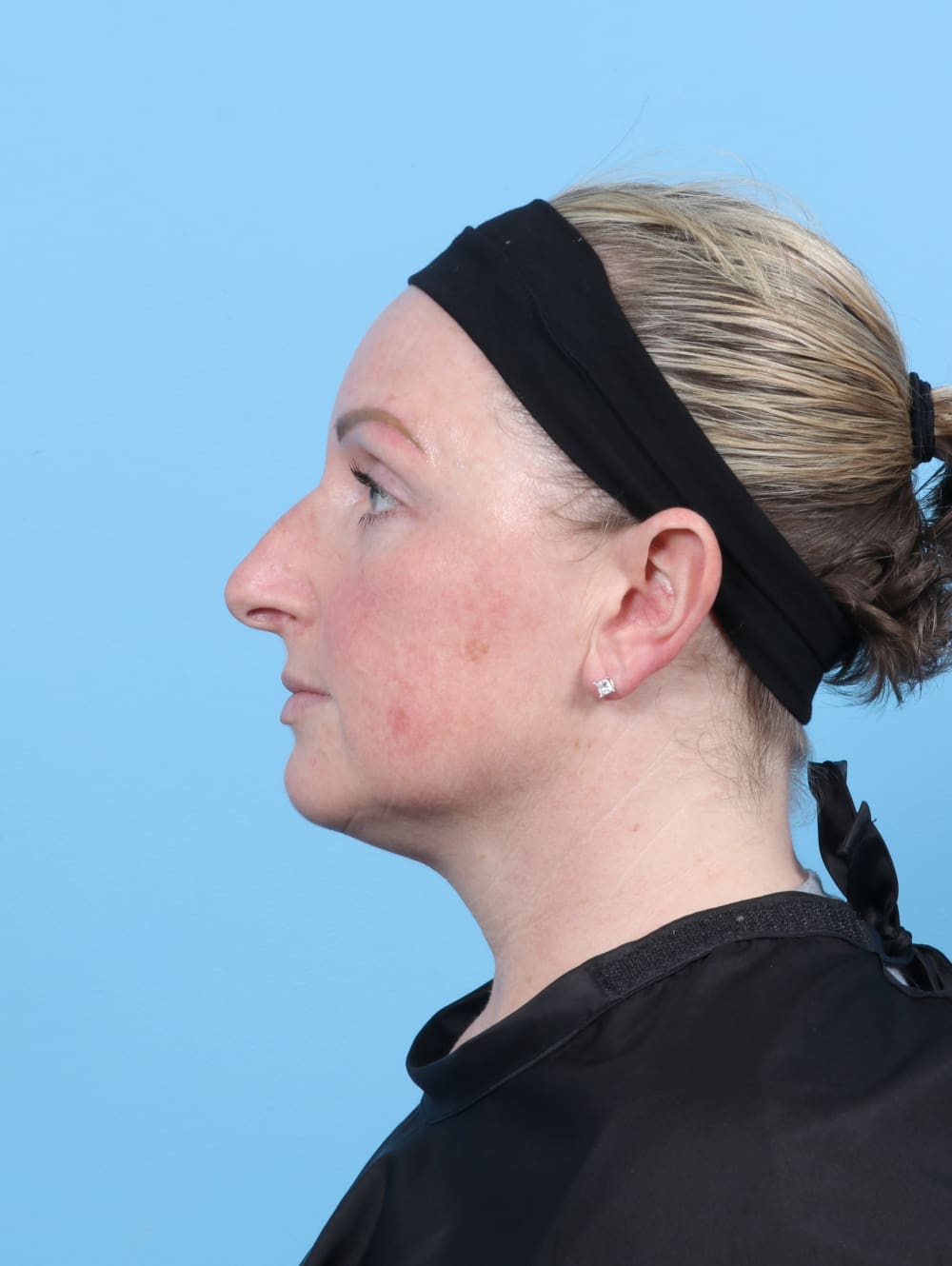 Rhinoplasty Patient Photo - Case 6205 - before view-