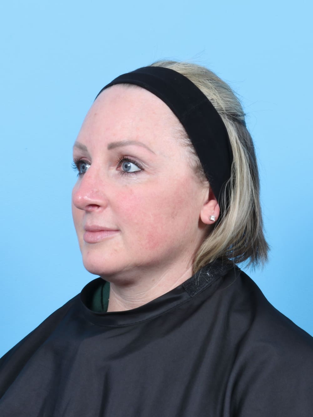 Rhinoplasty Patient Photo - Case 6205 - after view-2