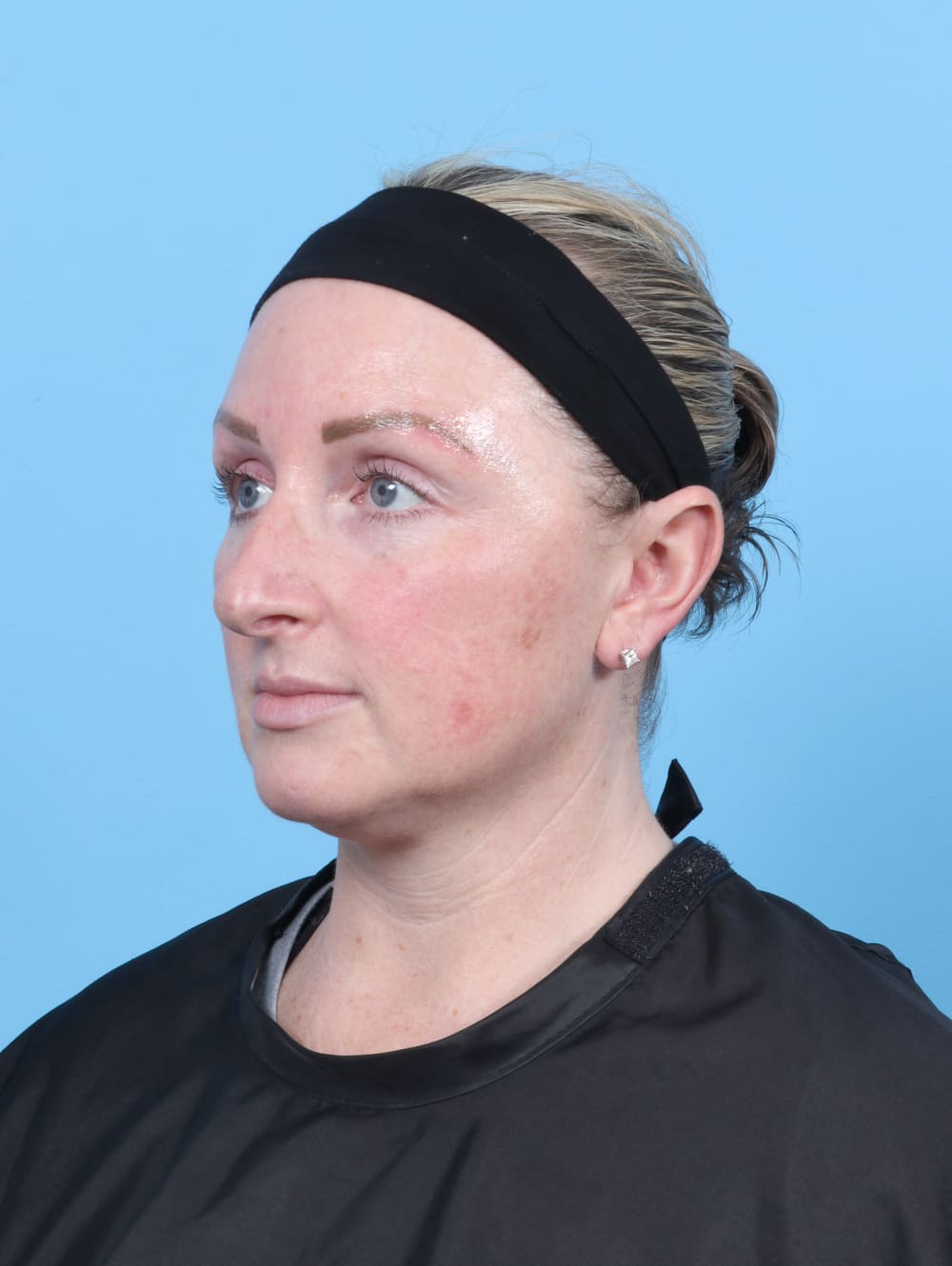 Rhinoplasty Patient Photo - Case 6205 - before view-2