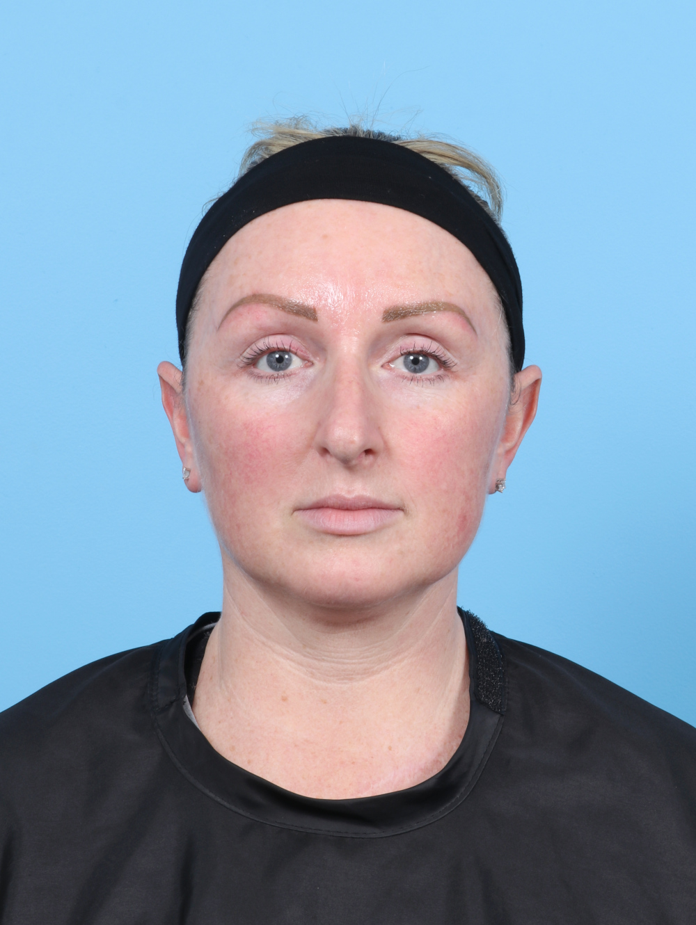 Rhinoplasty Patient Photo - Case 6205 - before view-1
