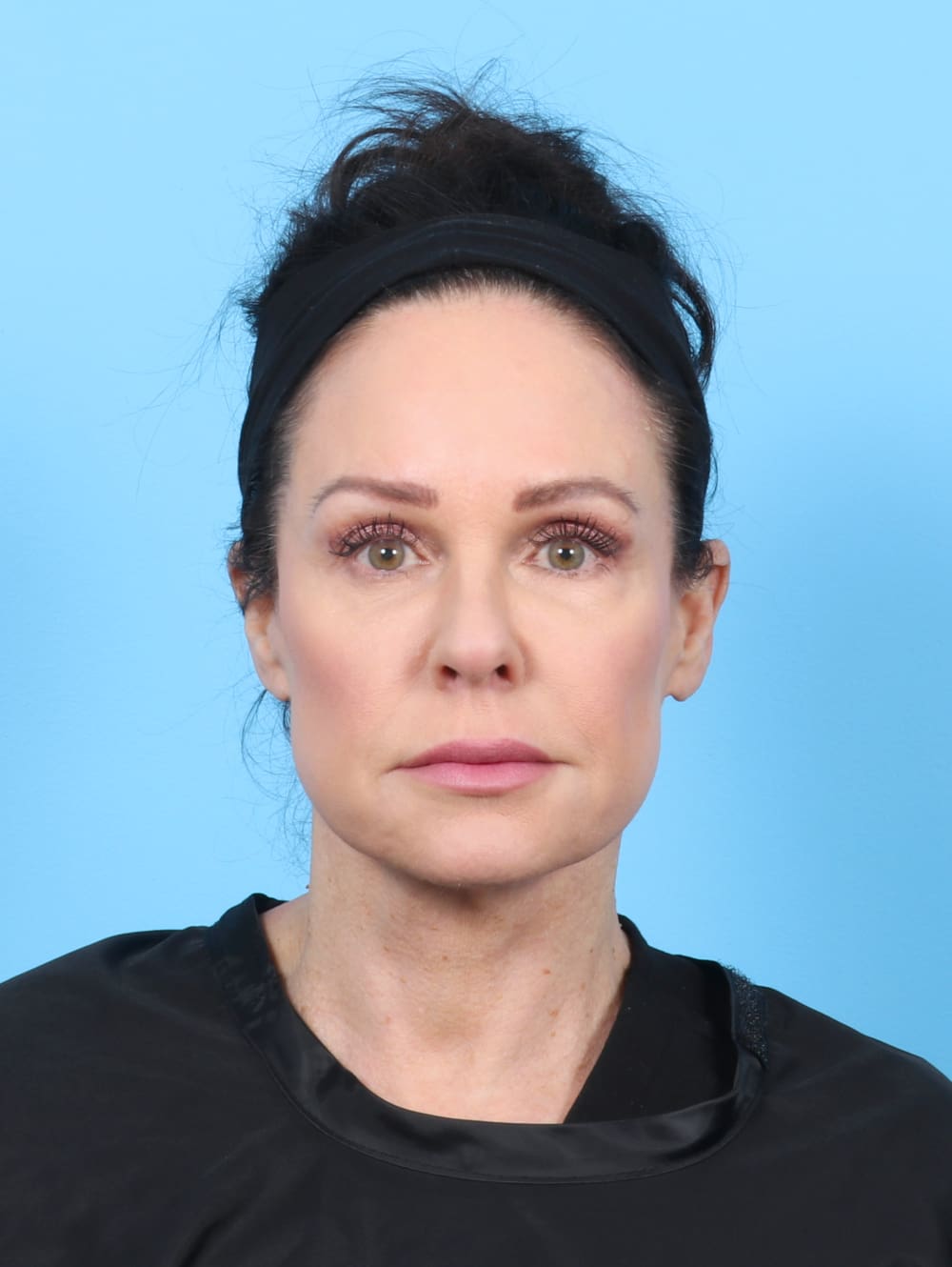 Facelift Patient Photo - Case 6261 - after view