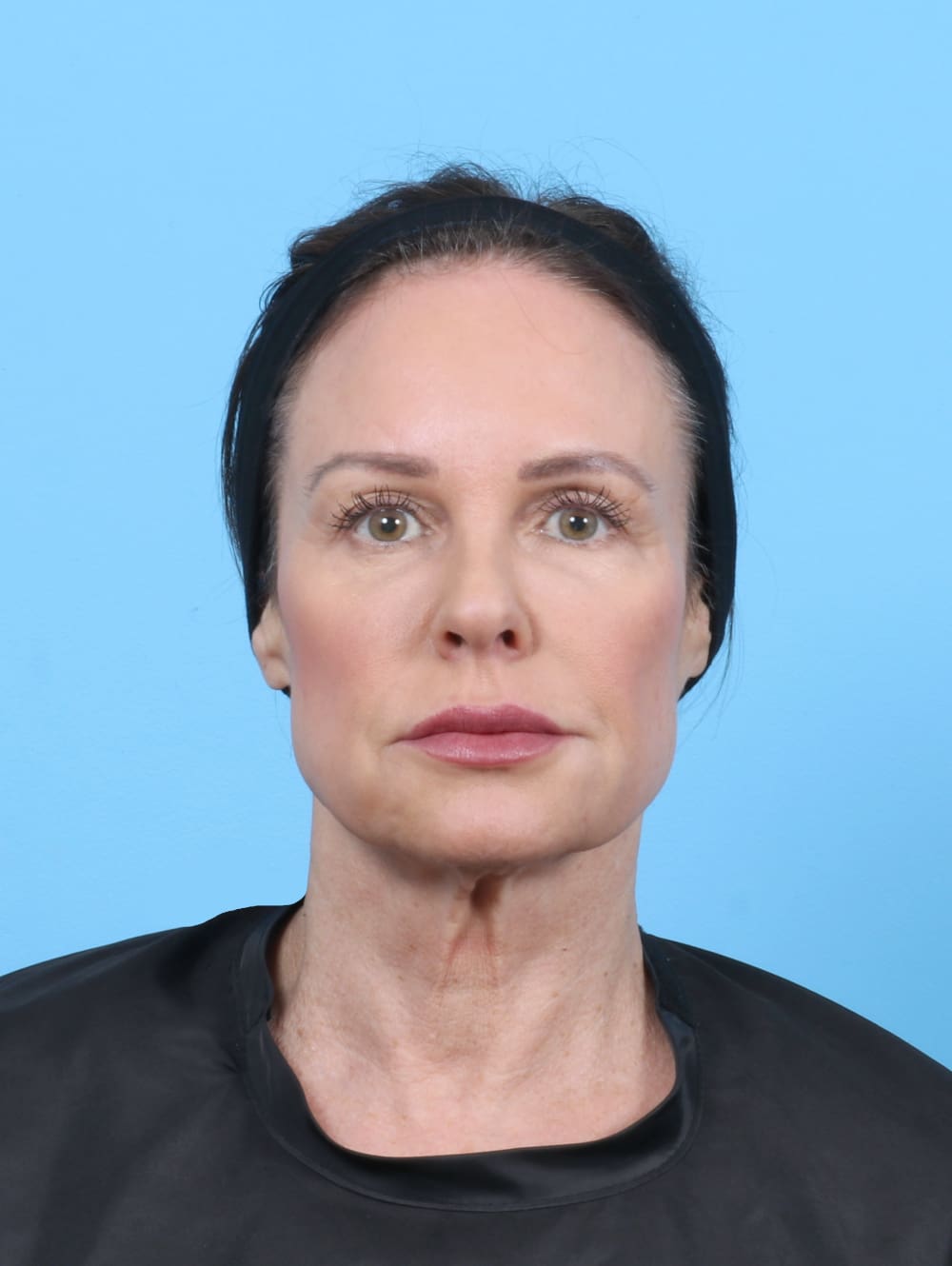 Facelift Patient Photo - Case 6261 - before view-