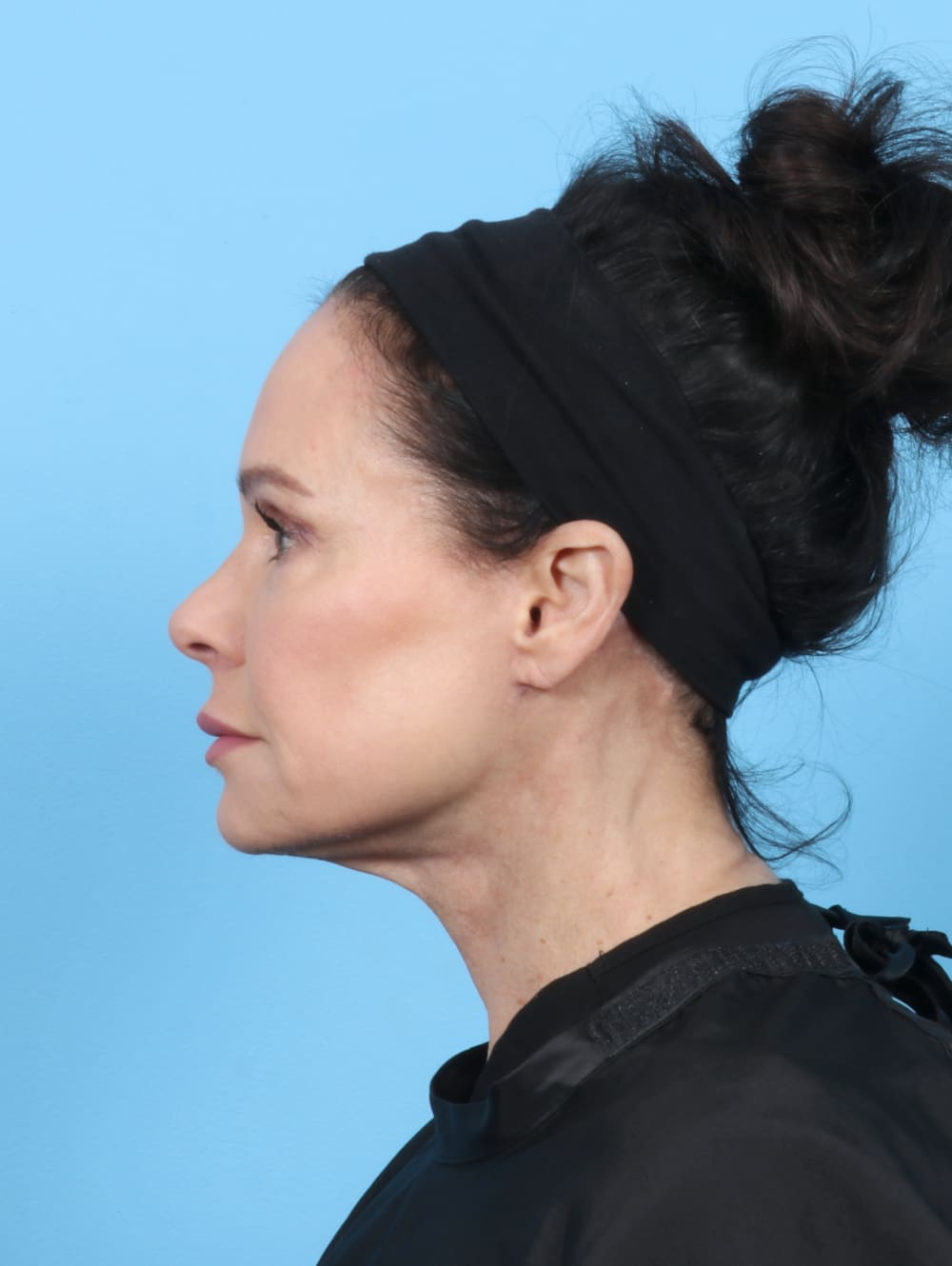 Facelift Patient Photo - Case 6261 - after view-2