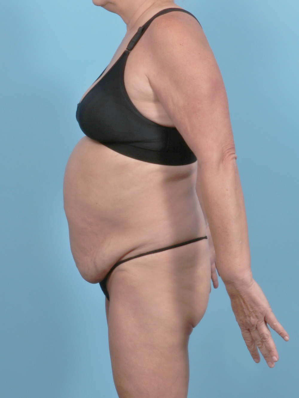 Tummy Tuck Patient Photo - Case 6301 - before view-2