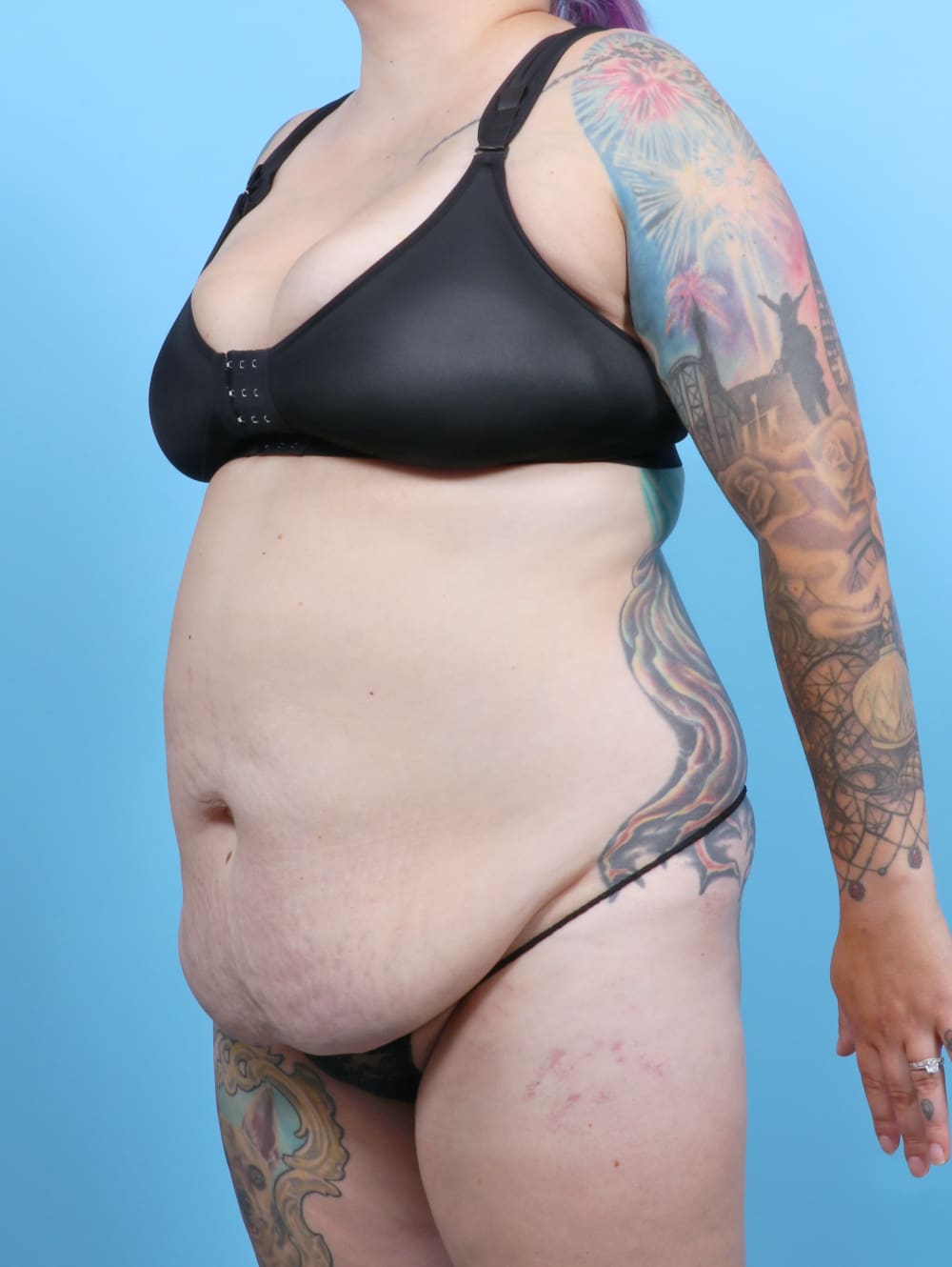 Liposuction Patient Photo - Case 6325 - before view-2