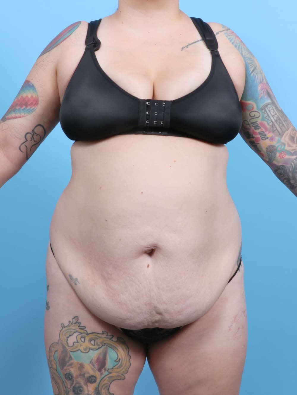 Liposuction Patient Photo - Case 6325 - before view-