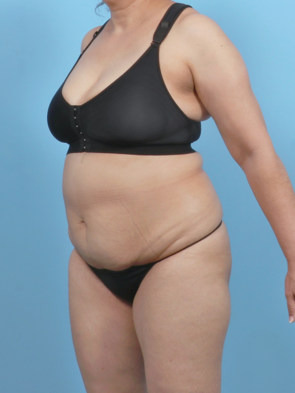 Tummy Tuck Patient Photo - Case 6351 - before view-1