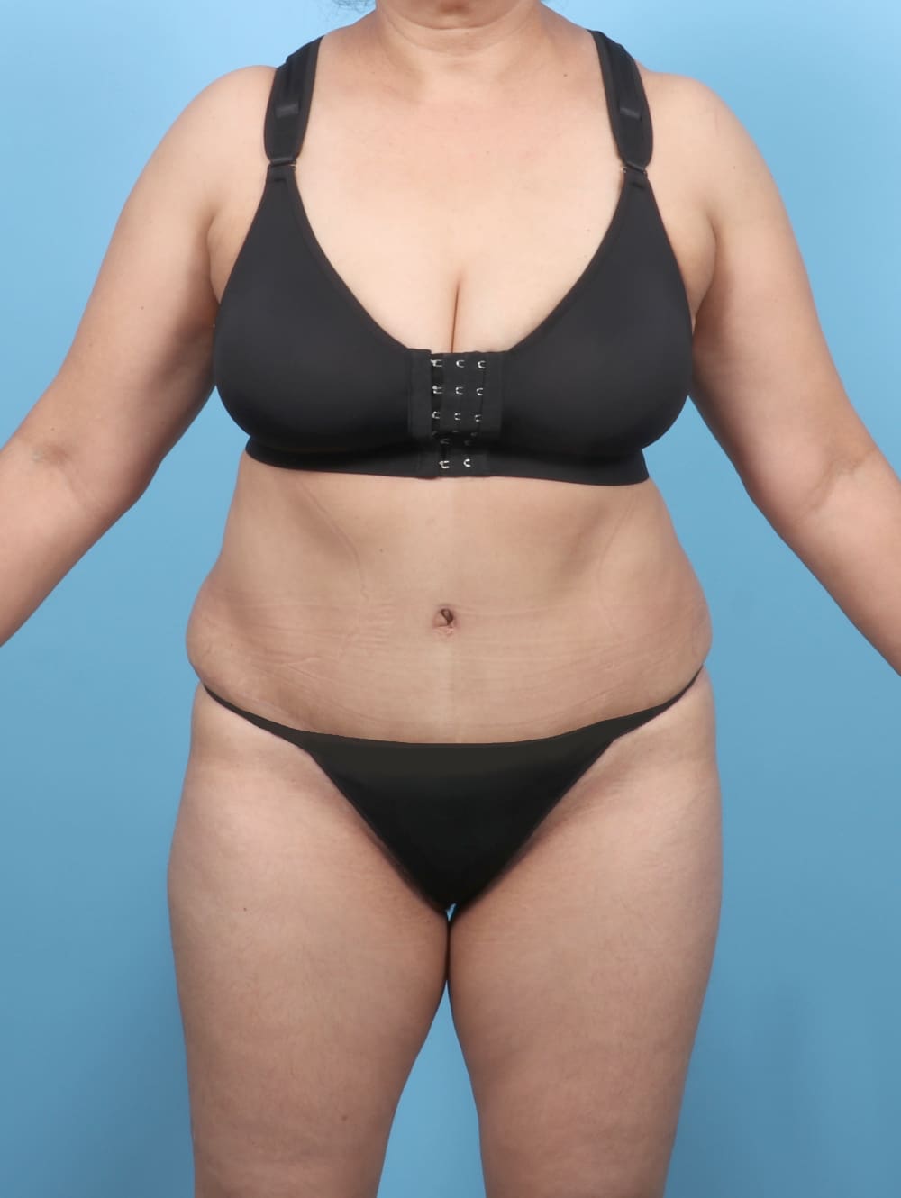 Tummy Tuck Patient Photo - Case 6351 - after view