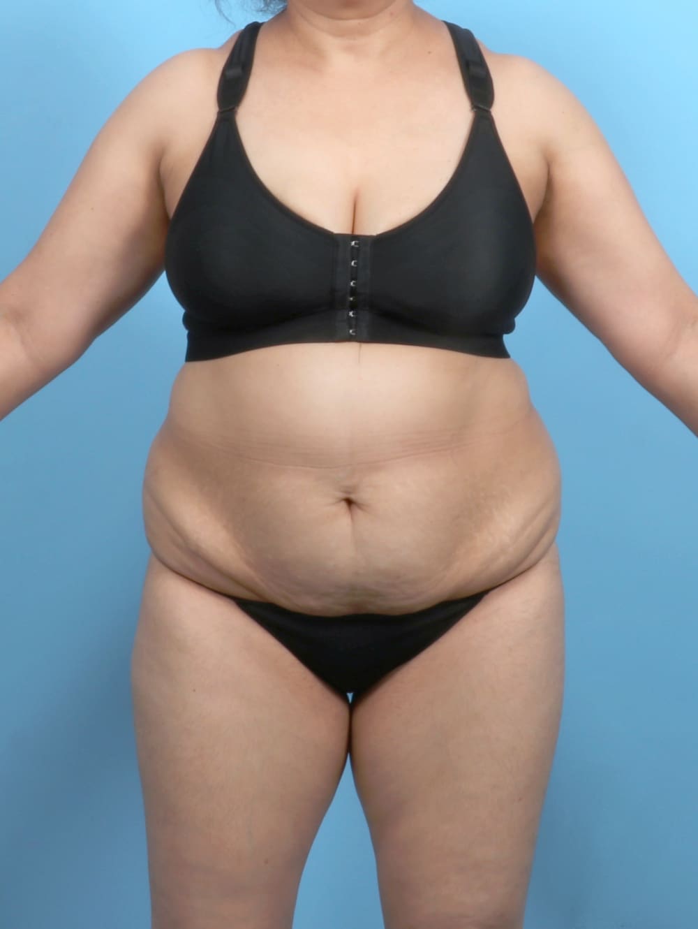 Tummy Tuck Patient Photo - Case 6351 - before view-