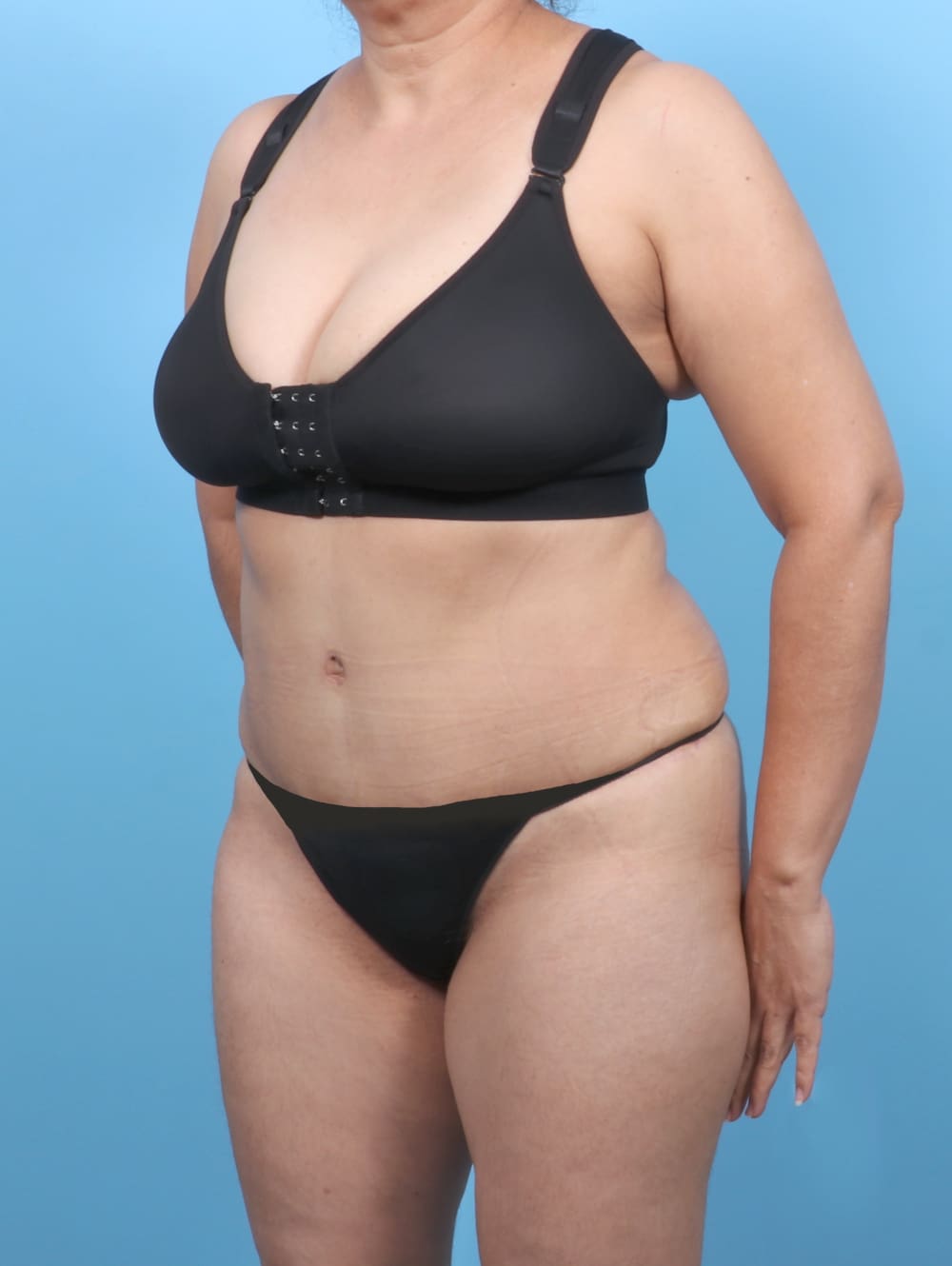 Tummy Tuck Patient Photo - Case 6351 - after view-1