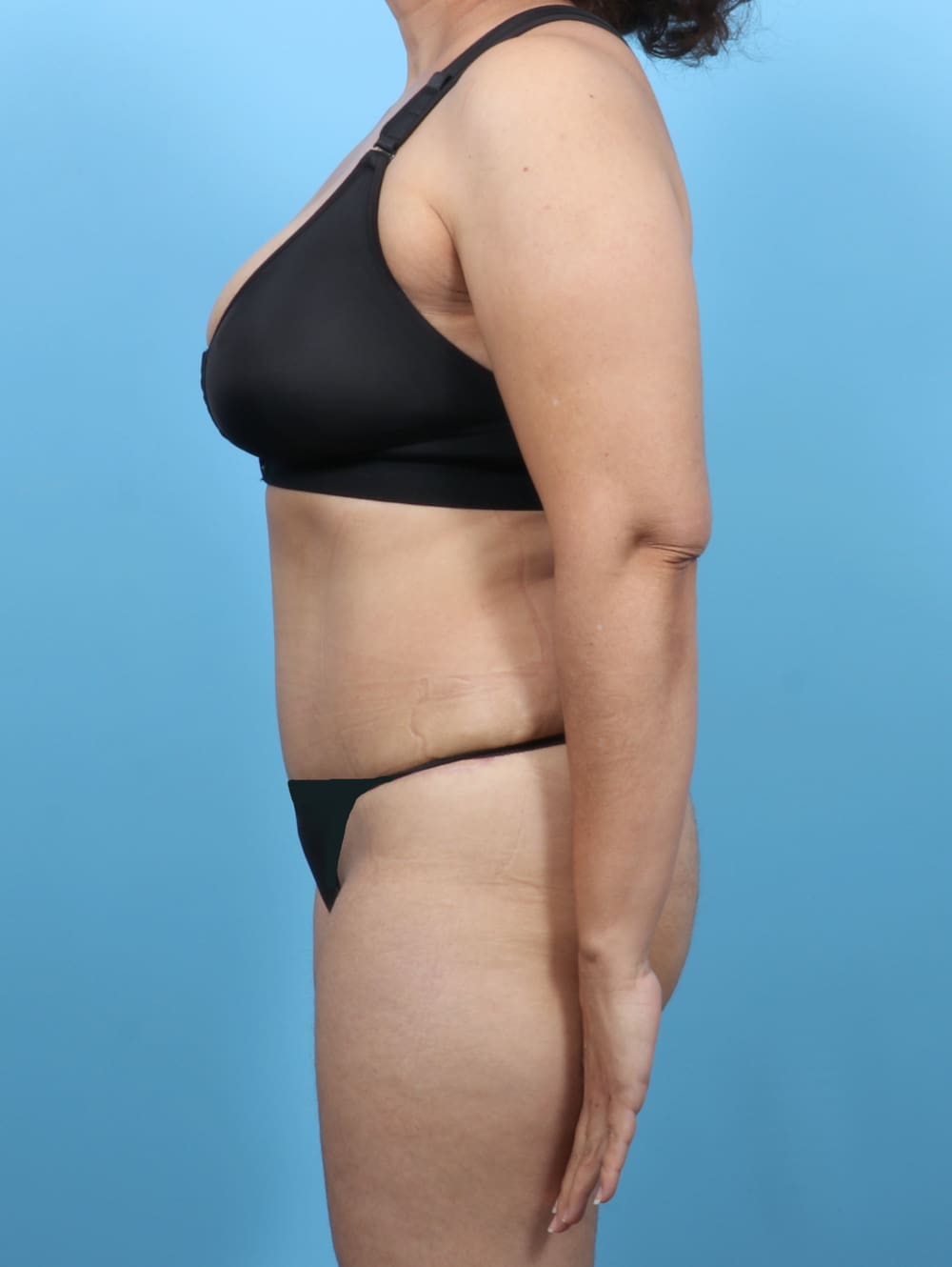 Tummy Tuck Patient Photo - Case 6351 - after view-2