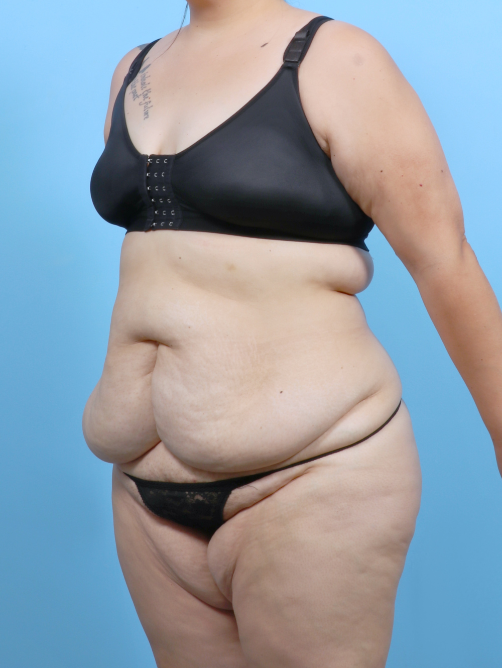 Tummy Tuck Patient Photo - Case 6383 - before view-1