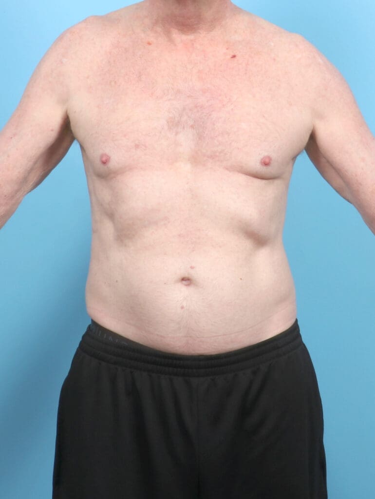 Male Breast Reduction - Case 6443 - Before