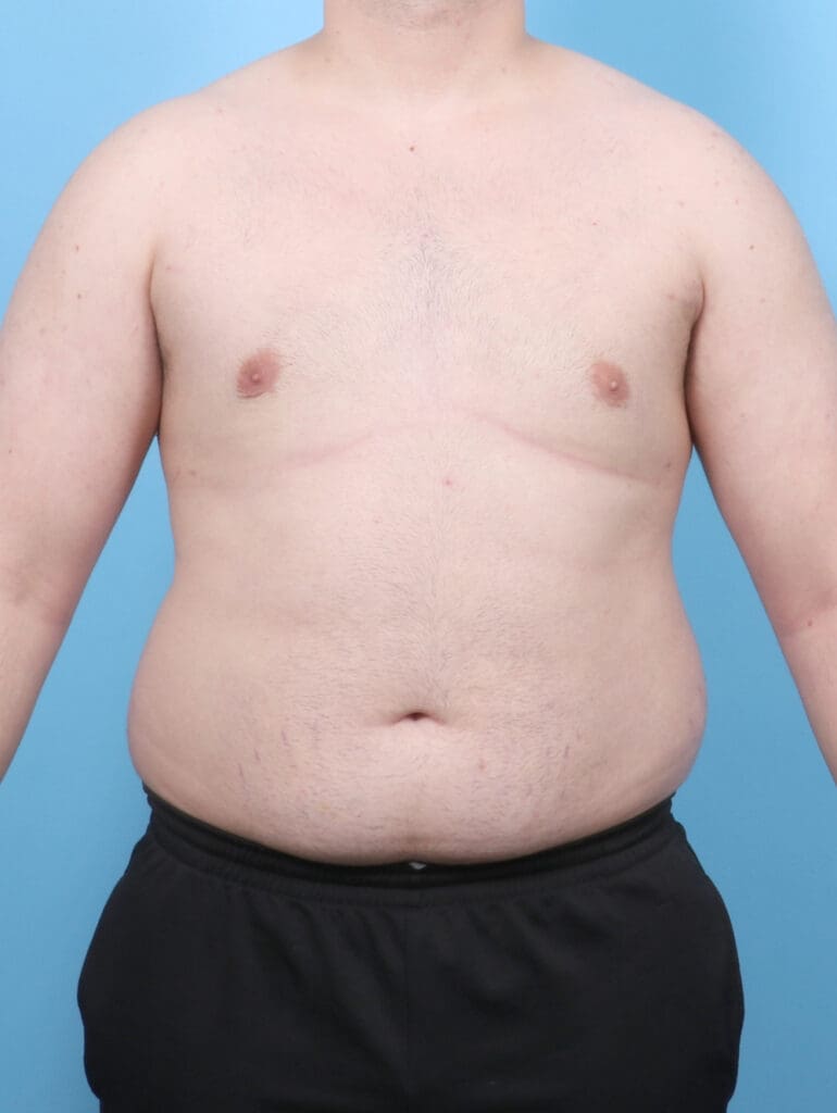 Male Breast Reduction - Case 6451 - After