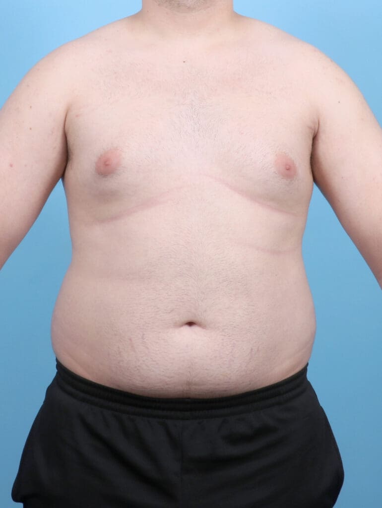 Male Breast Reduction - Case 6451 - Before