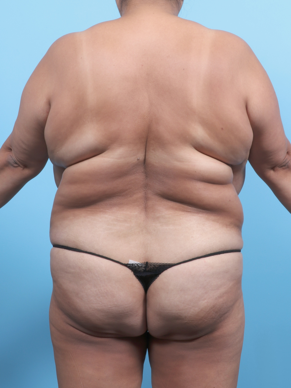 Liposuction Patient Photo - Case 6459 - before view-1