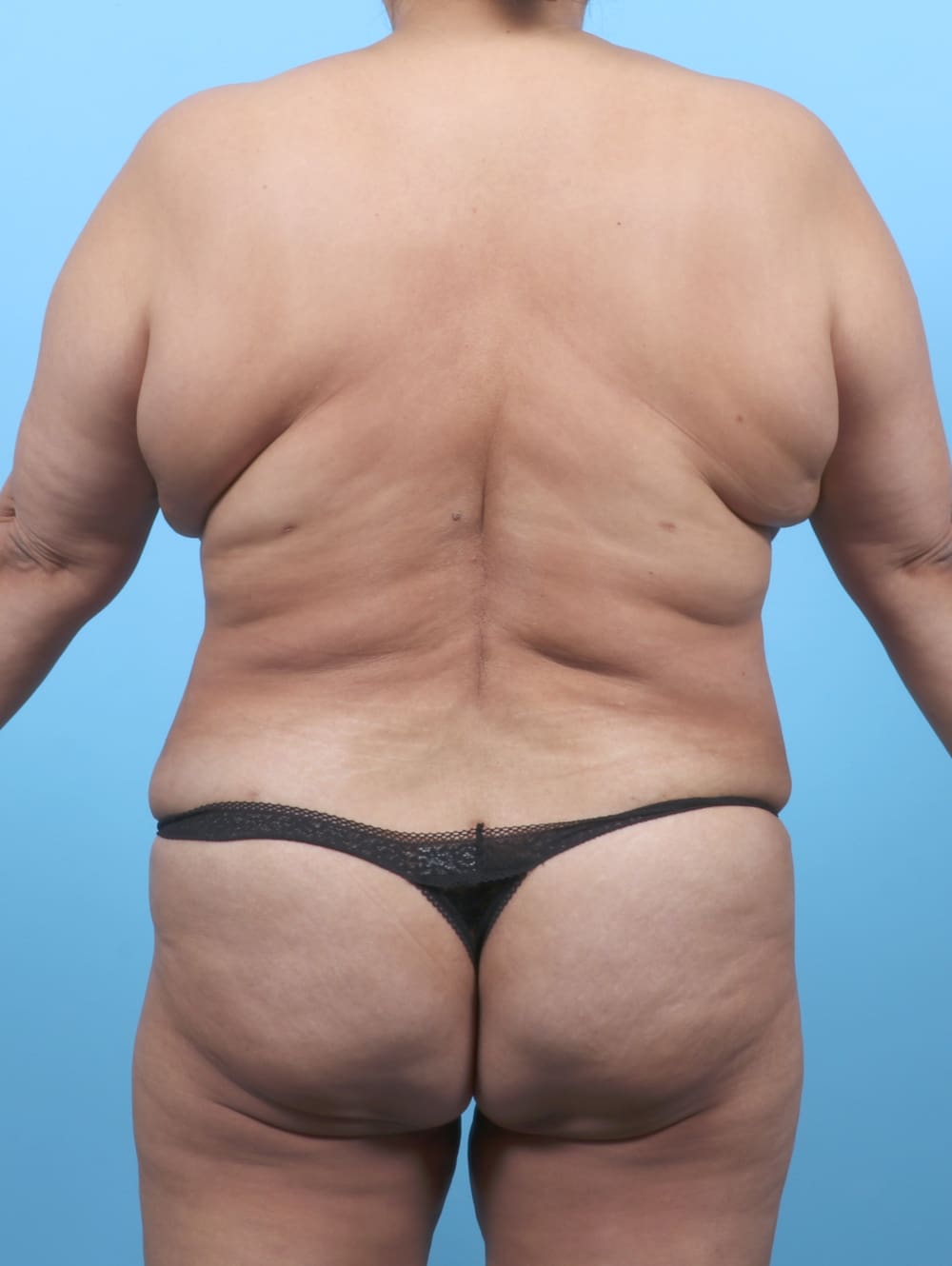 Liposuction Patient Photo - Case 6459 - after view-1