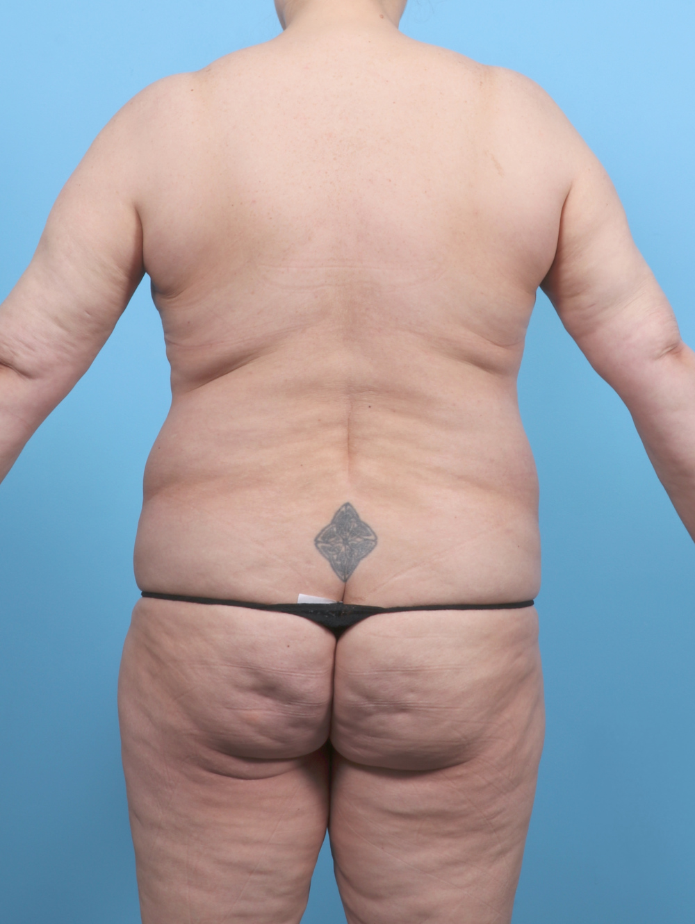 Liposuction Patient Photo - Case 6497 - before view-1