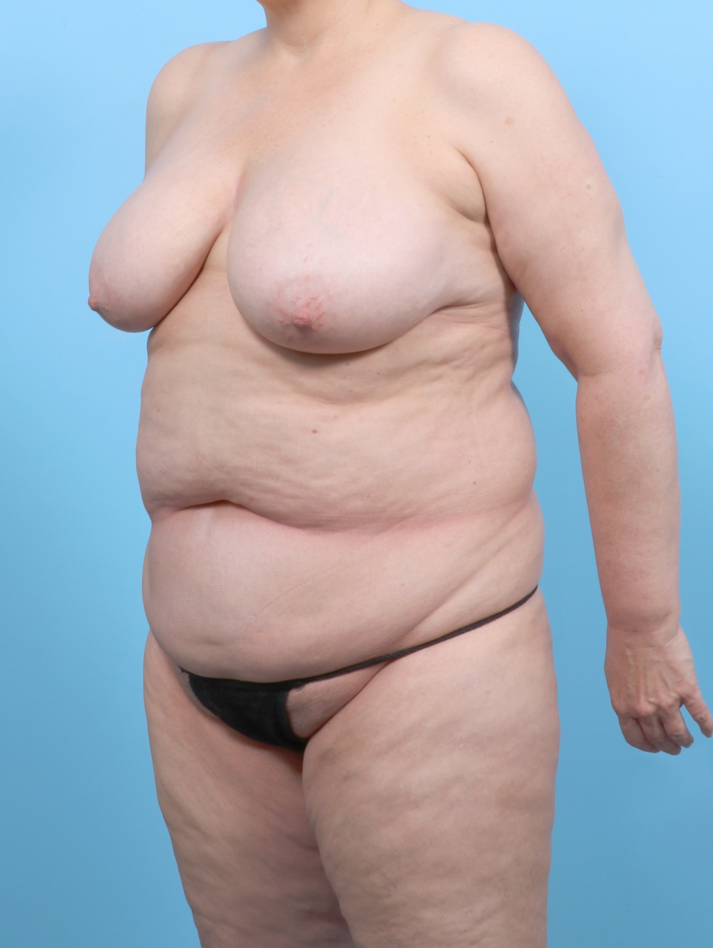 Liposuction Patient Photo - Case 6497 - before view-2
