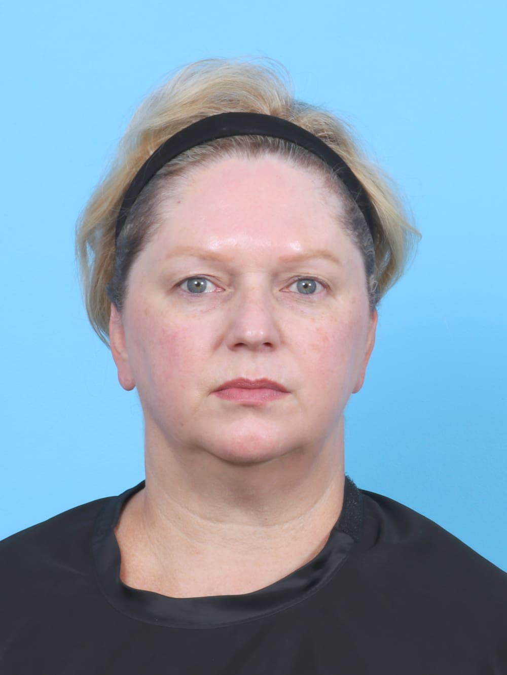 Eyelid Surgery Patient Photo - Case 6523 - before view-