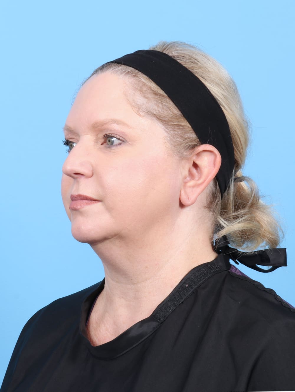 Eyelid Surgery Patient Photo - Case 6523 - after view-1