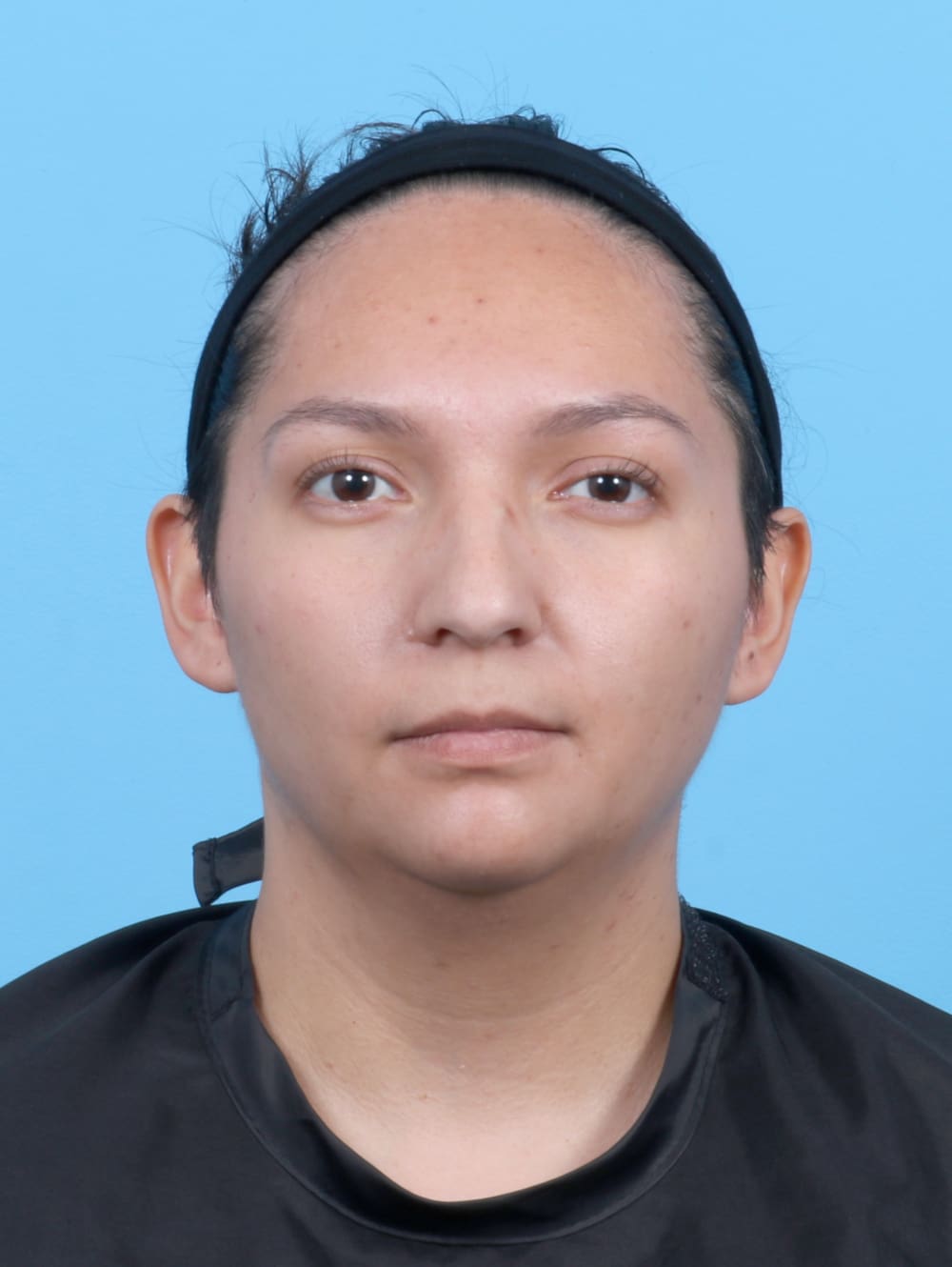 Liposuction Patient Photo - Case 6531 - before view-1