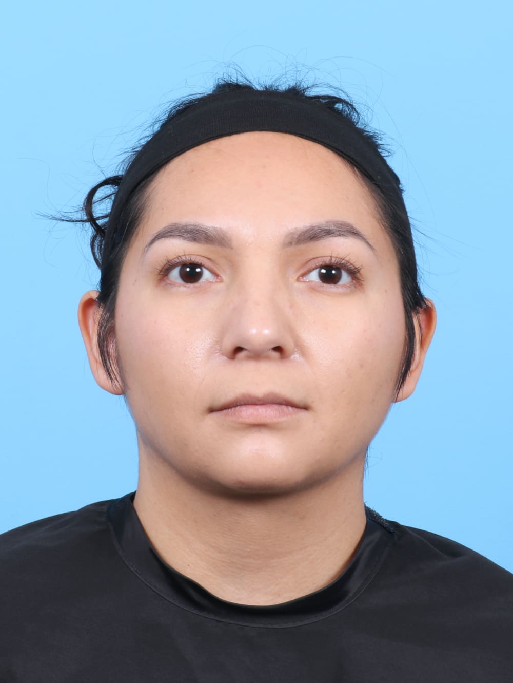 Liposuction Patient Photo - Case 6531 - after view-1