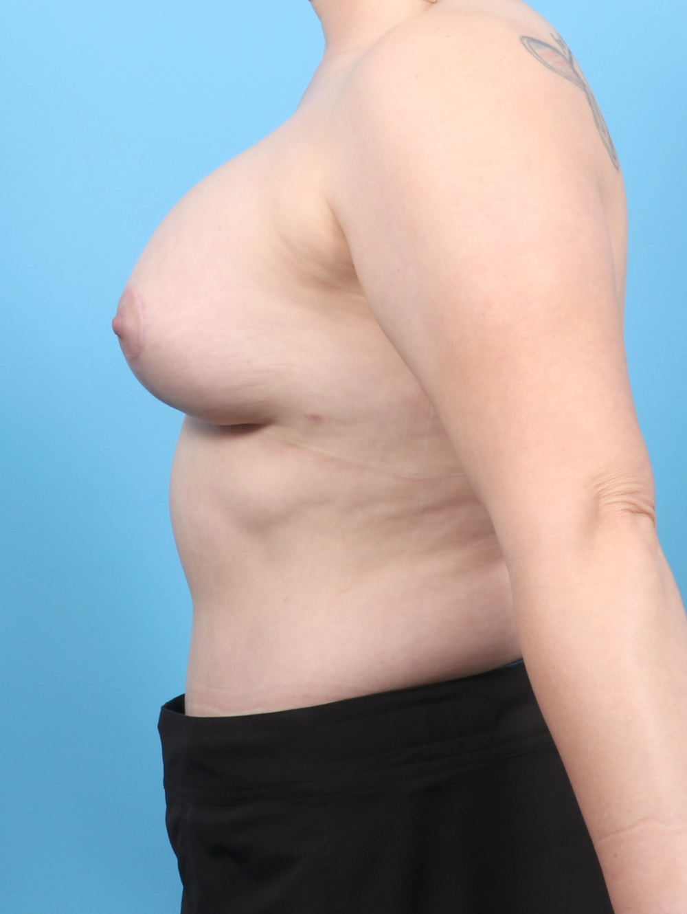 Breast Lift/Reduction Patient Photo - Case 6547 - after view-2