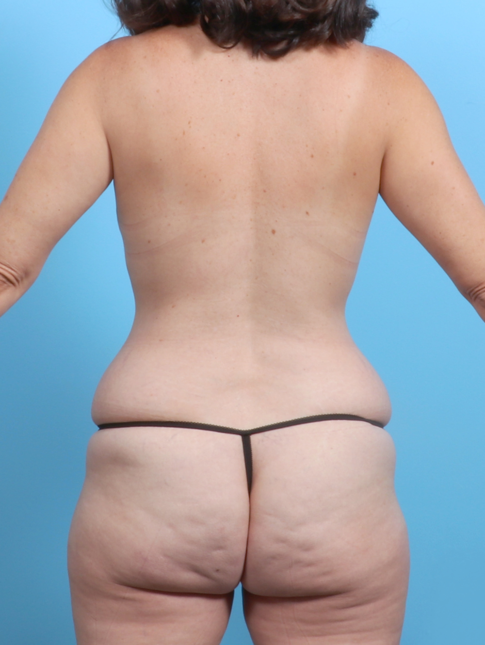 Liposuction Patient Photo - Case 6555 - before view-1