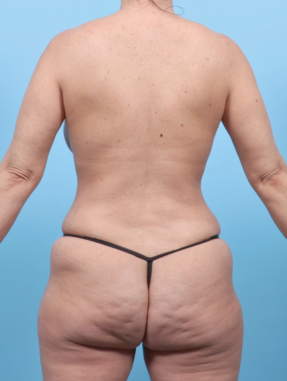 Liposuction Patient Photo - Case 6555 - after view-1