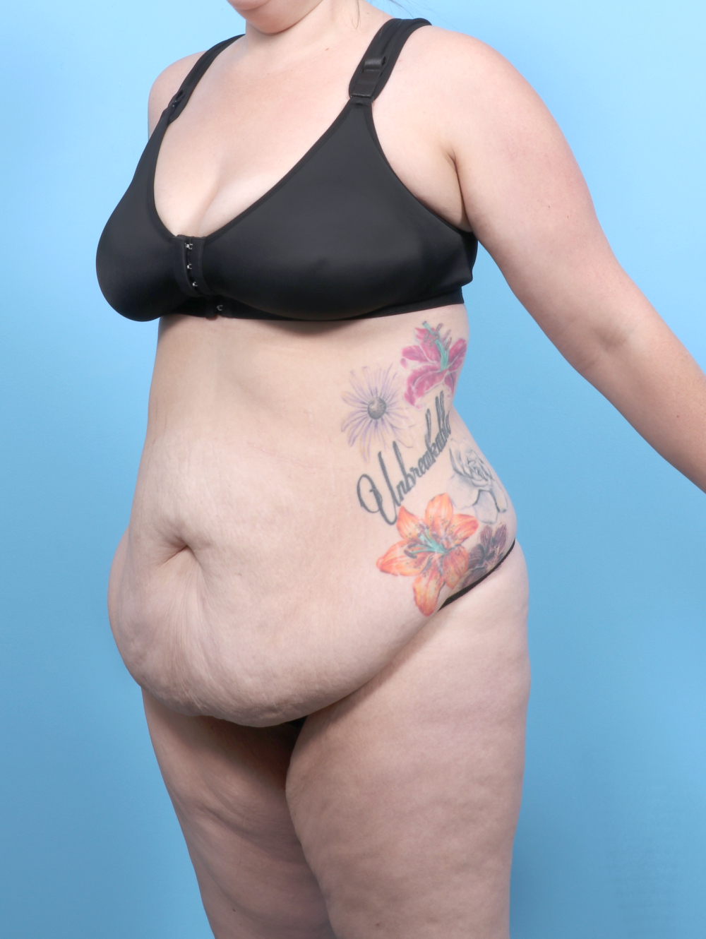 Tummy Tuck Patient Photo - Case 6565 - before view-1