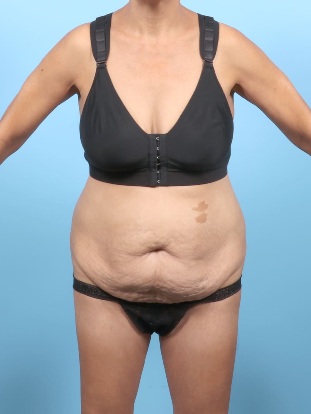Liposuction Patient Photo - Case 6651 - before view-