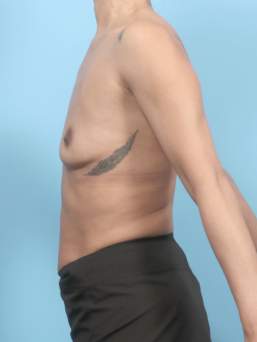 Breast Augmentation Patient Photo - Case 6669 - before view-2