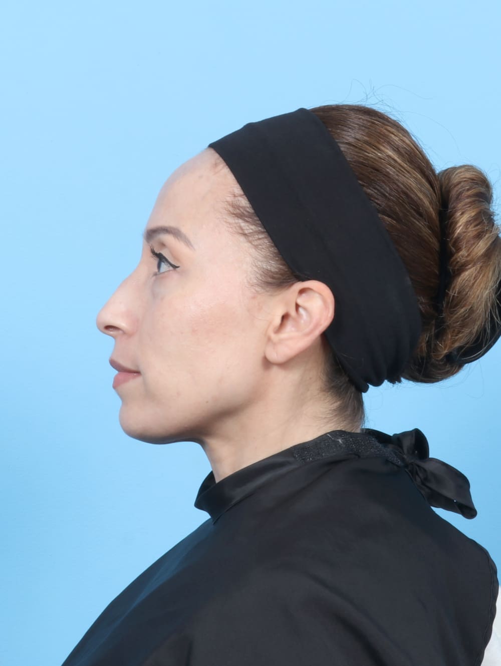 Eyelid Surgery Patient Photo - Case 6685 - before view-2