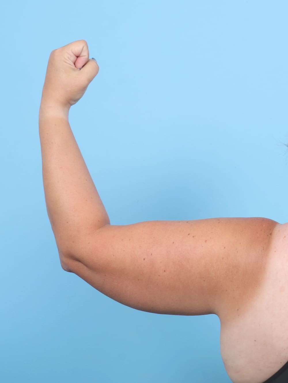 Liposuction Patient Photo - Case 6701 - before view-