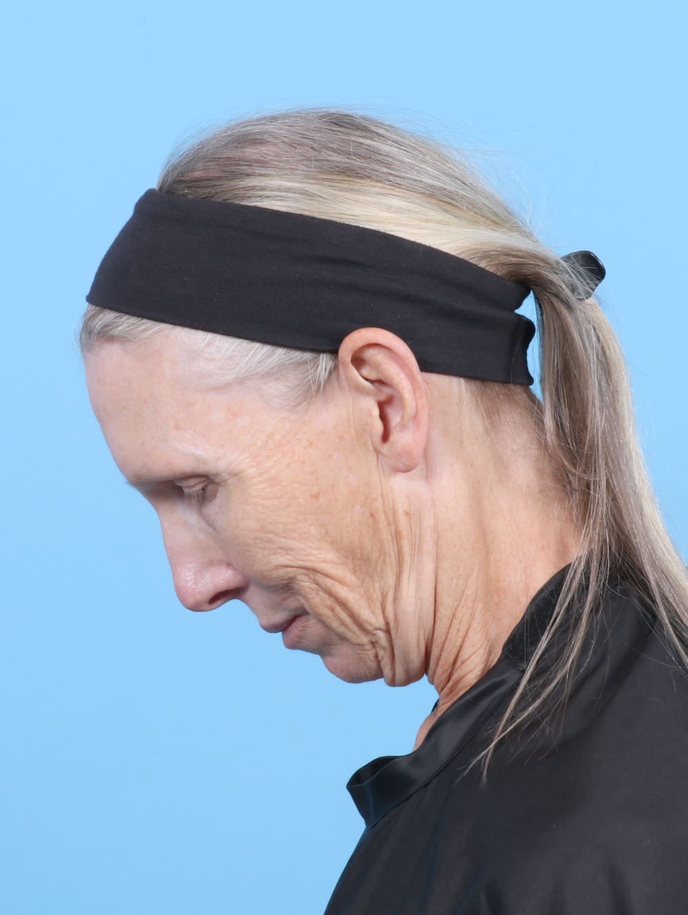 Facelift Patient Photo - Case 6725 - before view-3