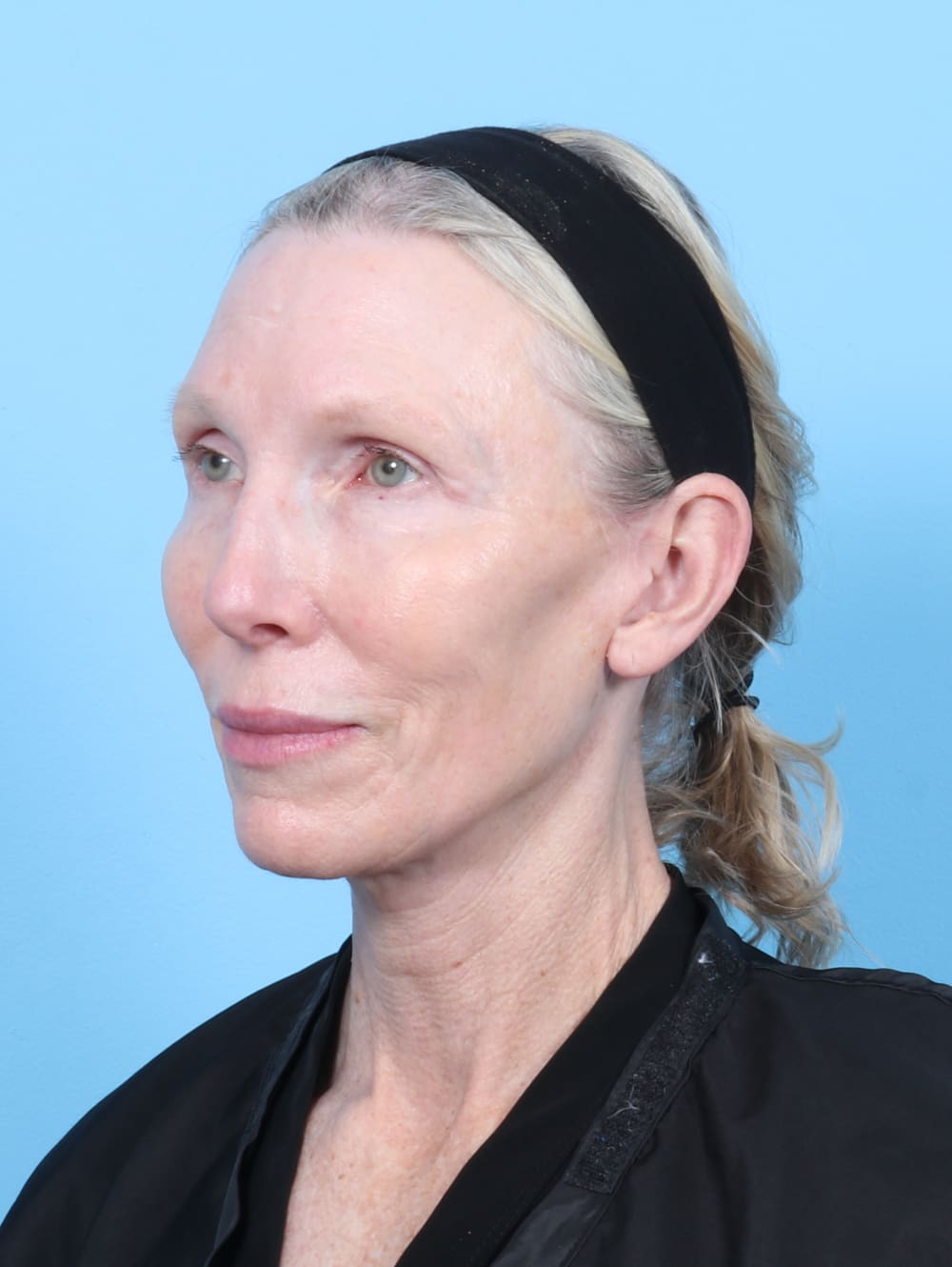 Facelift Patient Photo - Case 6725 - after view-1